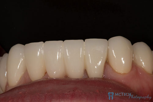 Maxillary and Mandibular Anterior Teeth Retracted View