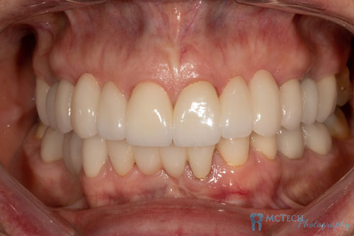 Maxillary and Mandibular Teeth Retracted View