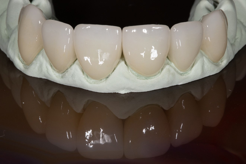 Close-up Dental Lab Work - Aesthetic